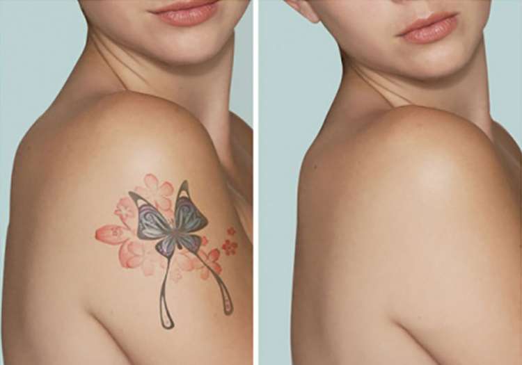Rimozione Tatuaggi
