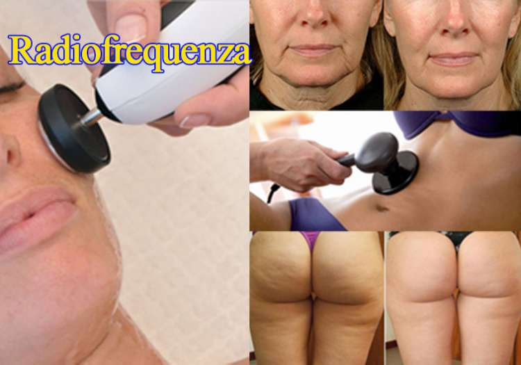 Trattamento di Radiofrequenza Viso e Corpo